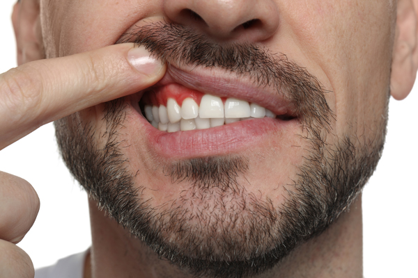Non Surgical Vs Surgical Gum Disease Treatment: What To Expect