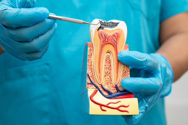 What’s The Difference Between A Root Canal And A Filling?