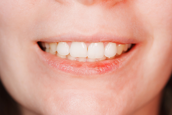 Professional Teeth Whitening Vs  At Home Kits: What Works Best?